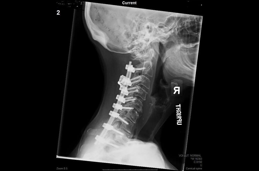 Posterior Cervical Fusions Dr Wayne Kelley Jr Md 9809